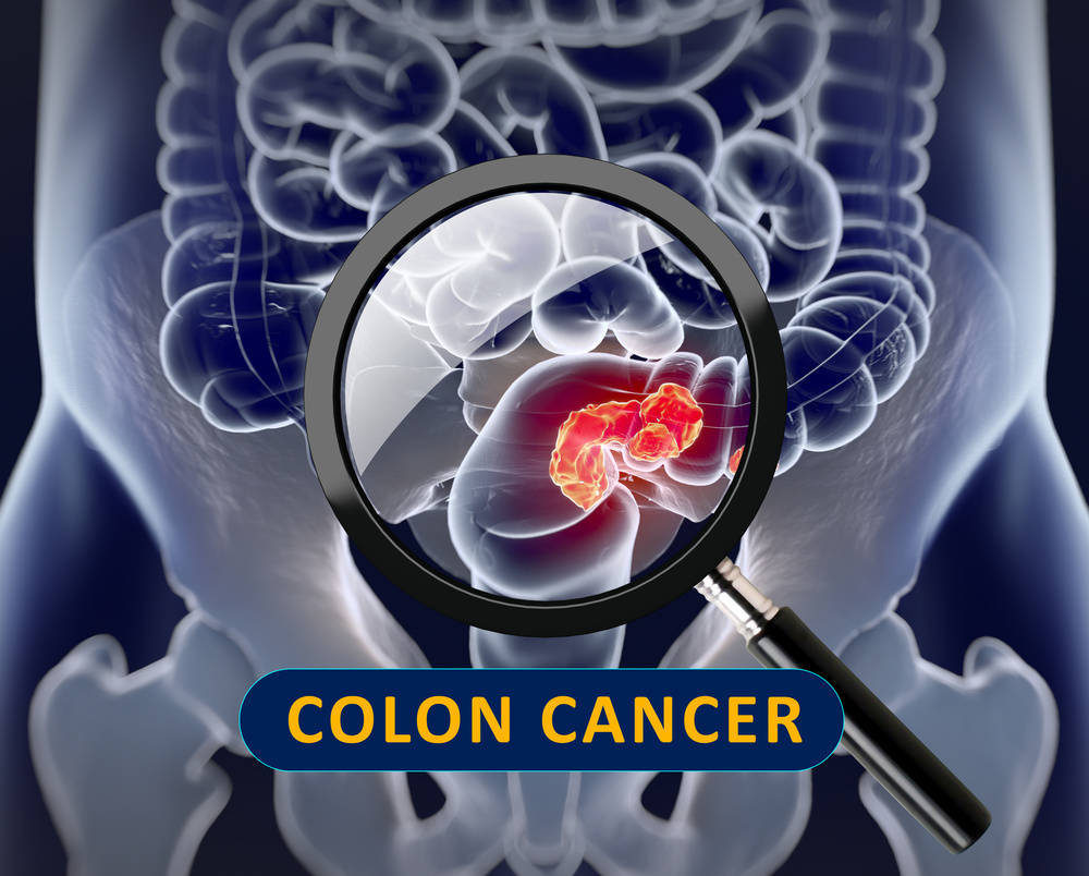 編者按:結腸癌(colon cancer,cc)是常見的發生於結腸的消化道惡性腫瘤