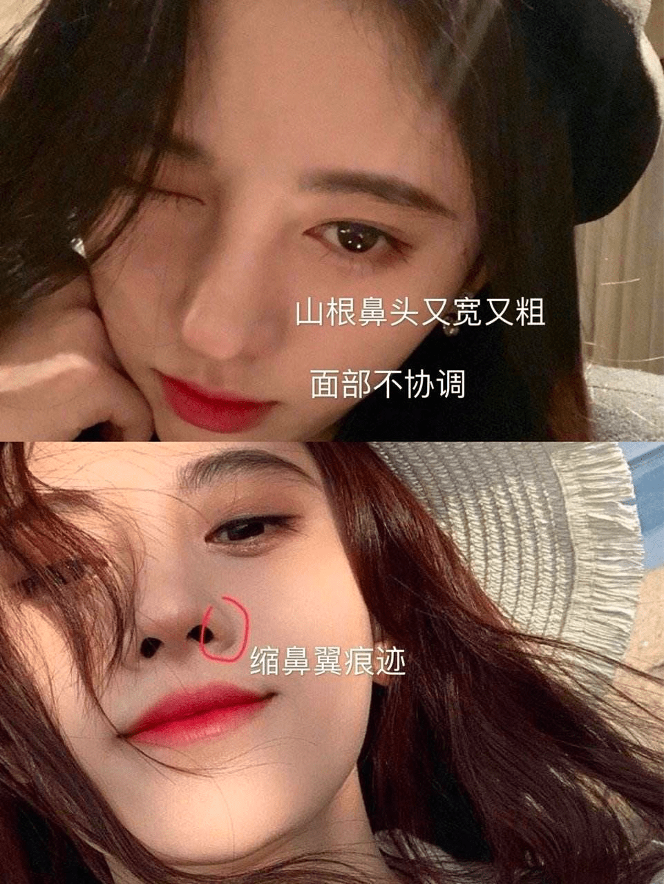 后遗症那些乱整鼻子的女星还好吗？后遗症一大堆，杨幂金晨都开始崩了