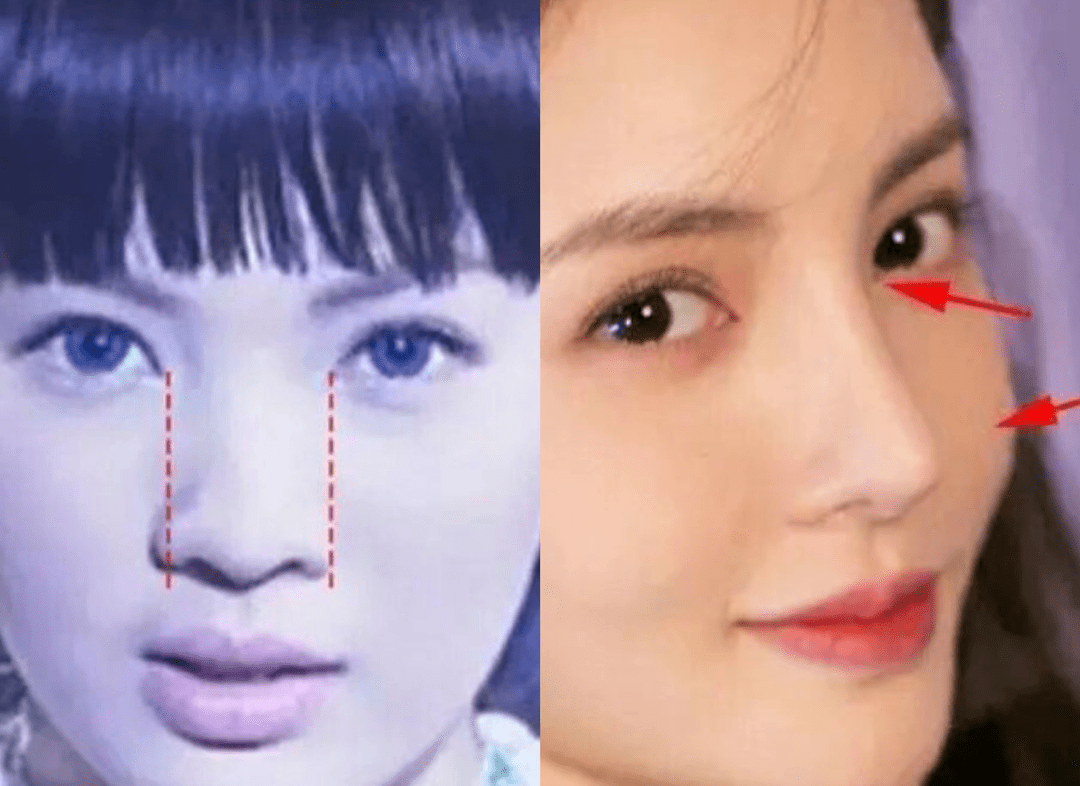 后遗症那些乱整鼻子的女星还好吗？后遗症一大堆，杨幂金晨都开始崩了