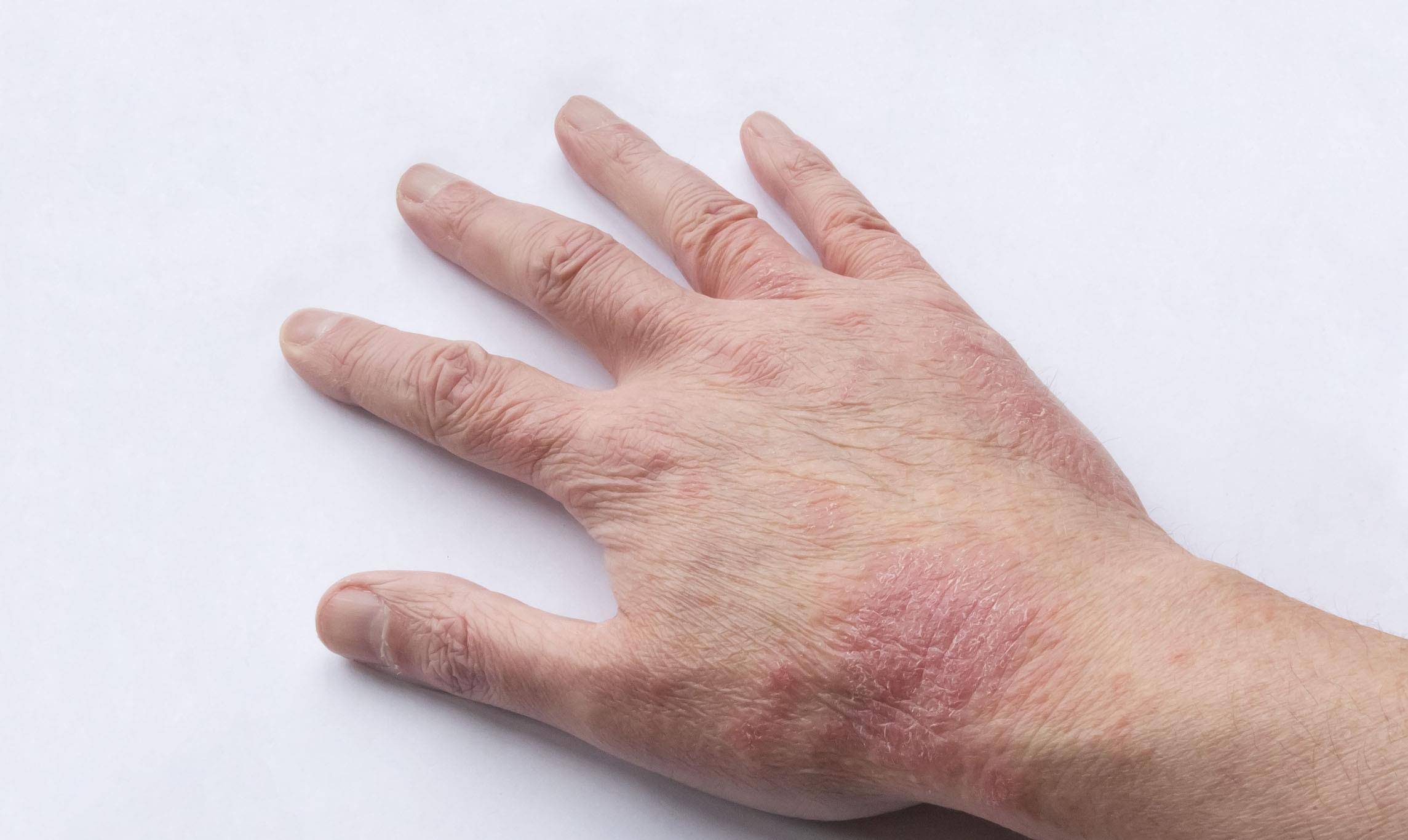 湿疹会给生活带来哪些影响？