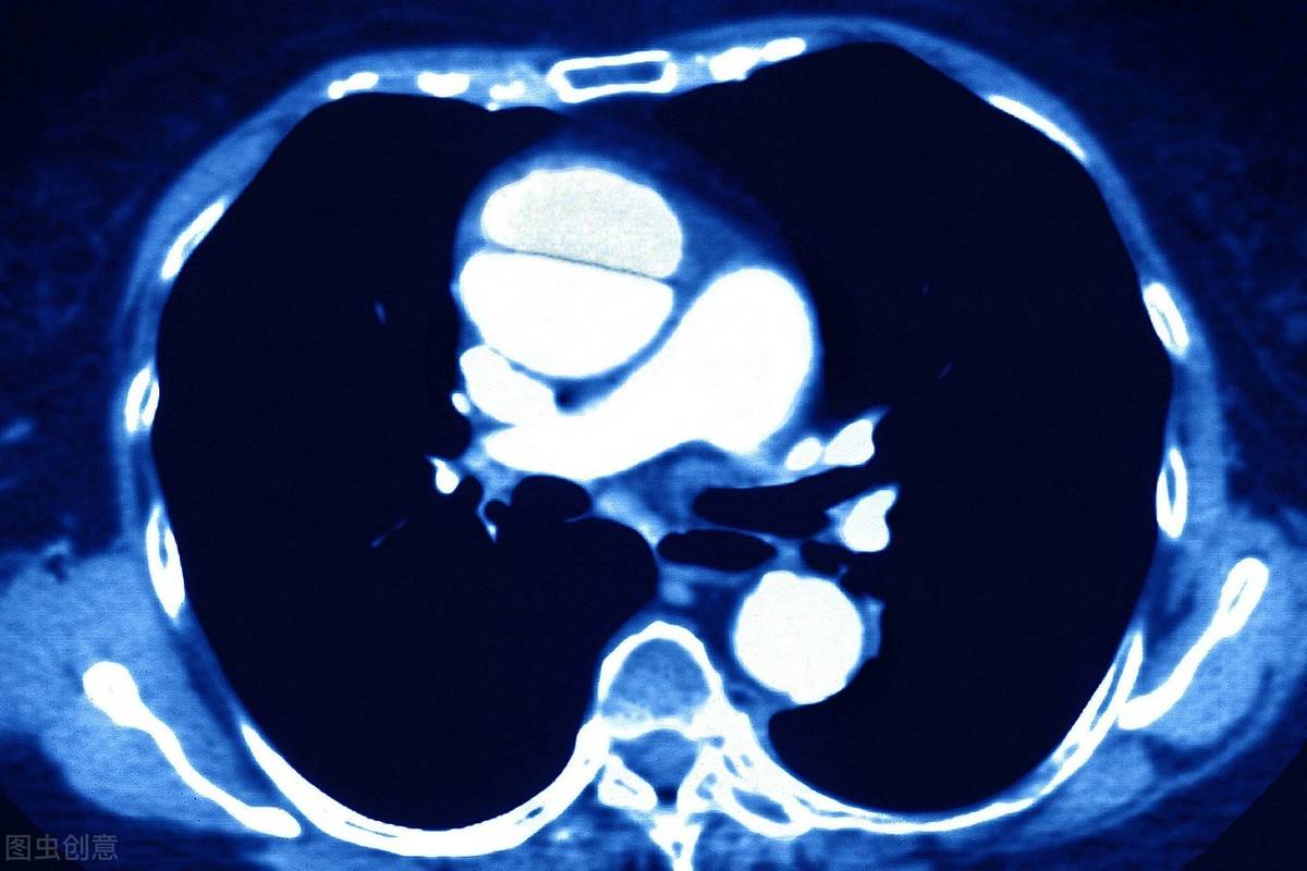 什么是主动脉夹层的早期症状 9a47afa75b1c4e8490e36652579905a8.jpeg