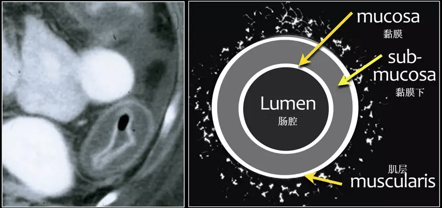 腸壁增厚的ct診斷_結腸_下圖_病人