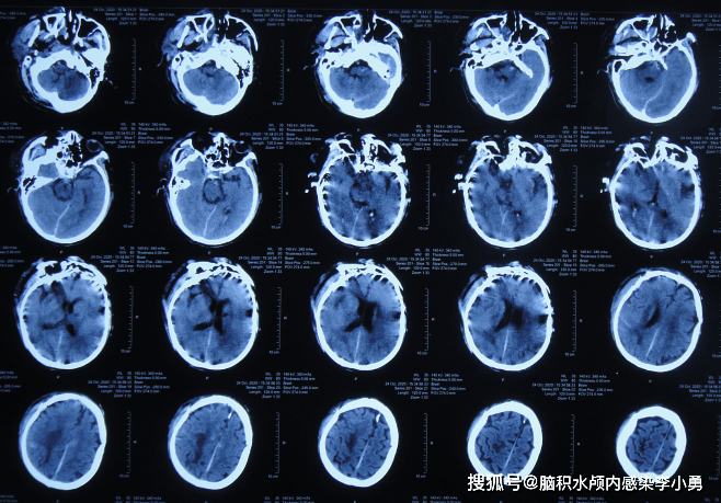 偶有胡言亂語,但雙側鼻孔流血性腦脊液,查頭顱ct示腦挫裂傷,腦水腫(圖