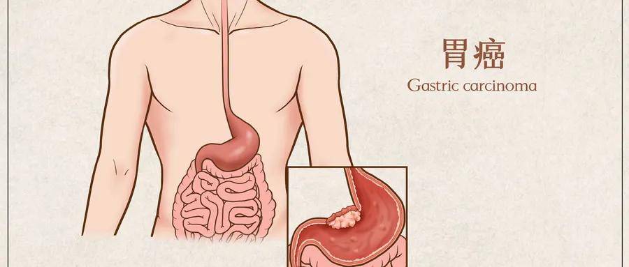 癌变|萎缩性胃炎是癌变的前奏？它真的是胃癌的“近亲”吗？