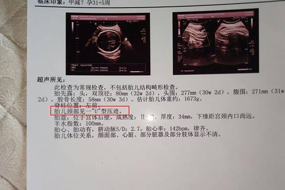 胎儿脐带绕颈一周怎么办啊 ef5eb50e57ad449494af76585a0ee727.jpeg