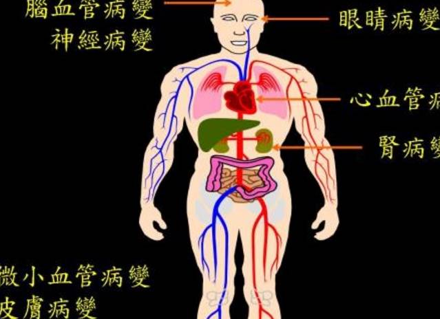 并发症|你的糖尿病是轻还是重？教你一个判断糖尿病轻重程度的方法！