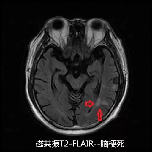 科普| 急性缺血性腦卒中 影像檢查要先行_磁共振_序列_患者