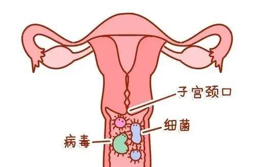 宫颈糜烂分泌物图图片