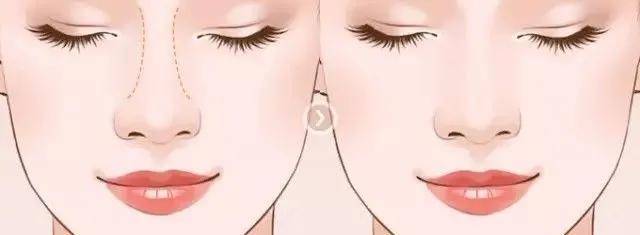 张磊鼻整形医生张磊：想要打造混血鼻子需要以下四个必备因素