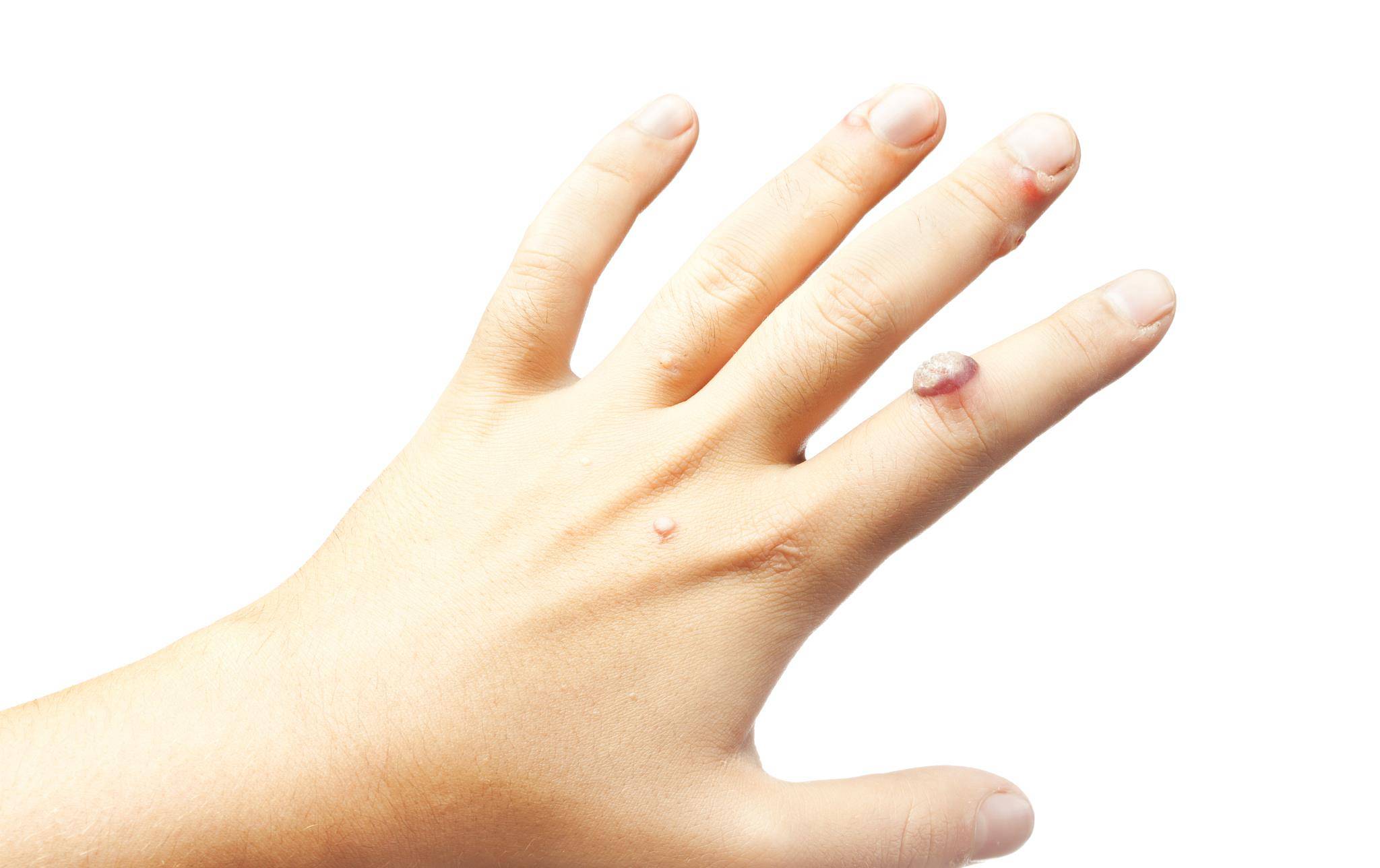 寻常疣什么情况下会扩散、严重？