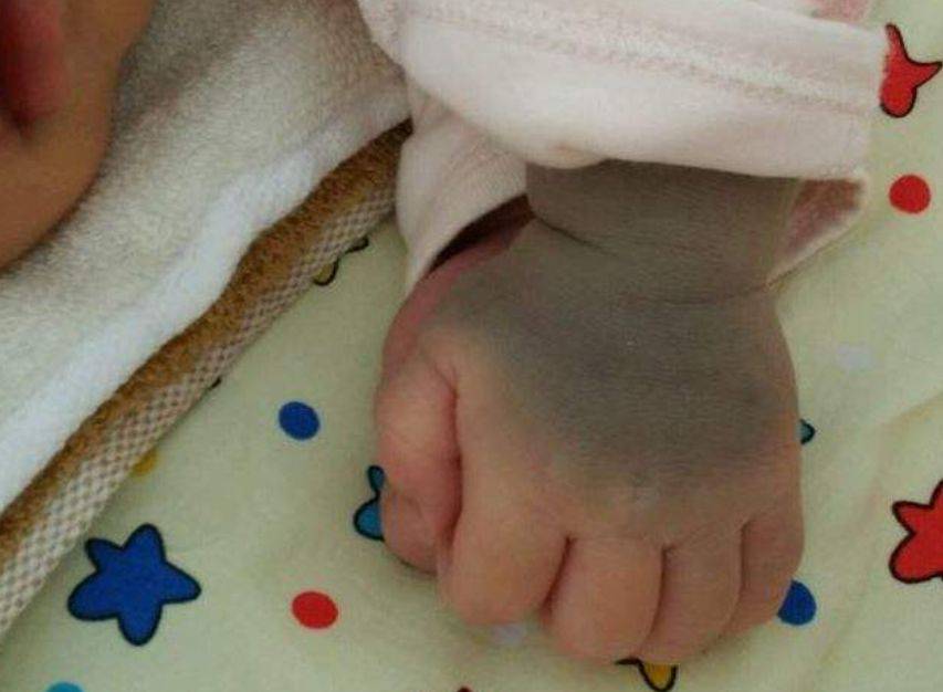 原来胎记有那么多门道避免宝宝长胎记孕妈这些行为要注意