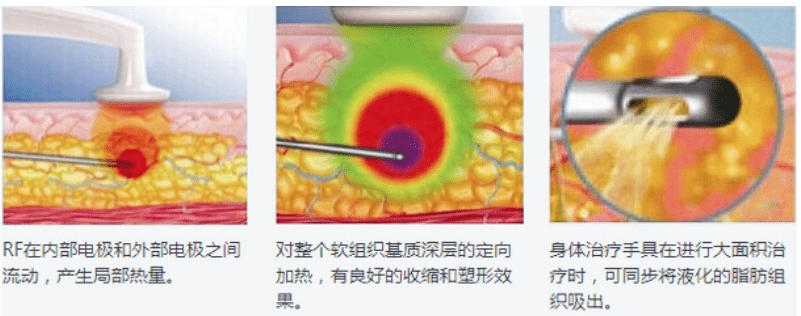 能量微雕和线雕的区别？线雕的后遗症、危害都是真的吗？