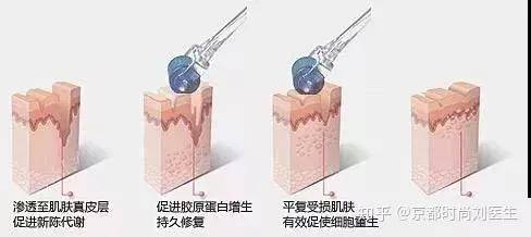果酸女孩挤痘痘诱发败血症?祛痘千万不能做的那些事儿！纯干货祛痘指南分享!