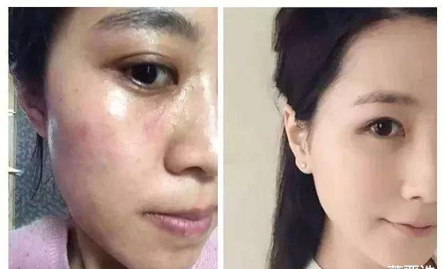 毛孔王源脸上痘痘越发严重，众人呼吁让他戒烟，美颜滤镜都救不了