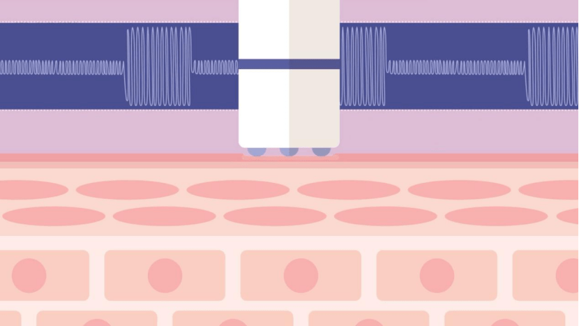 疗法用科技塑造美丽,雅光水婴肌,“解密”网红项目水婴肌