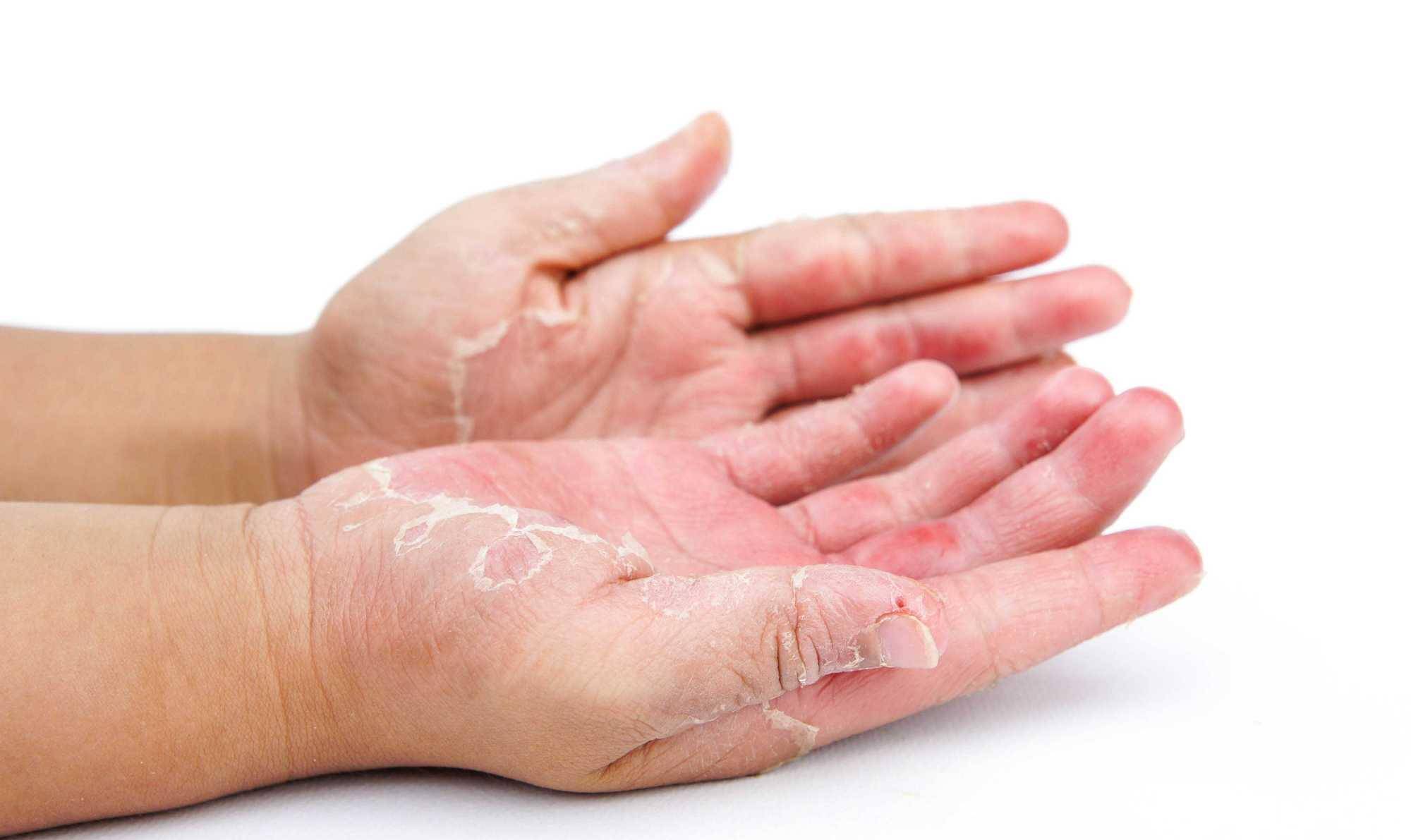 孩子手部脱皮严重怎么办?