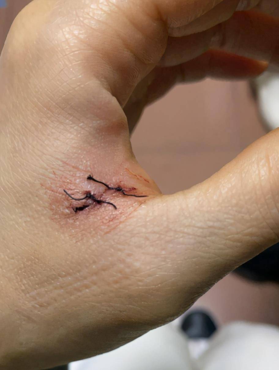 海毛虫咬到伤口 搜狗图片搜索