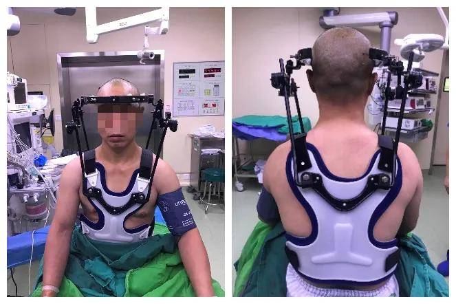 我以前看别人都是用石膏固定,看起来好像很难受……上颈椎损伤后,对于