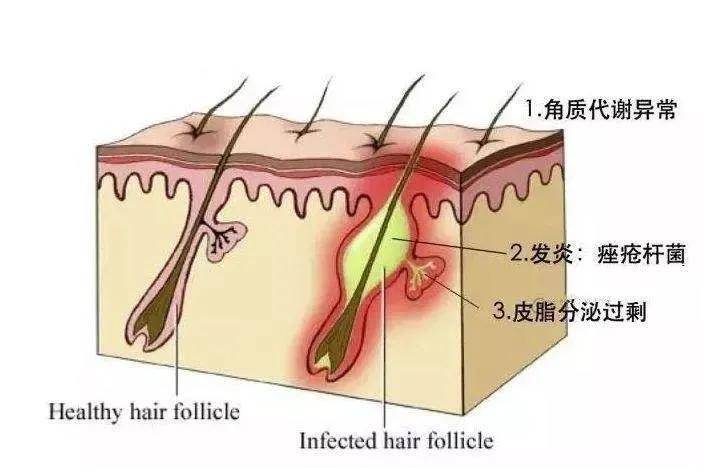 黑头她说自己的美貌主要归功于坚持不懈的皮肤管理？
