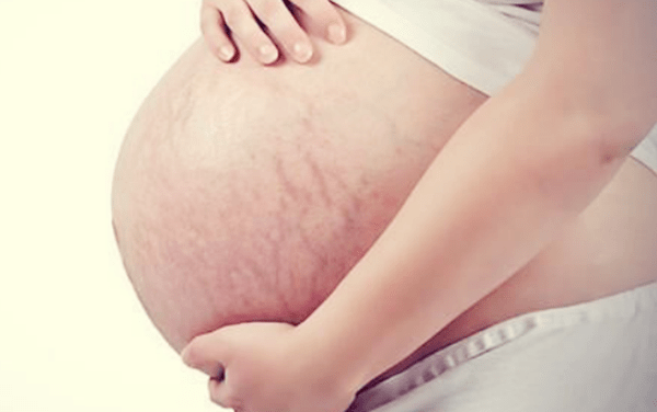 肚皮|孕期出现这三种情况，就是要长妊娠纹的“征兆”，孕妈要提早预防
