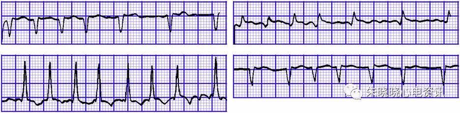 心室颤动心电图表现图片