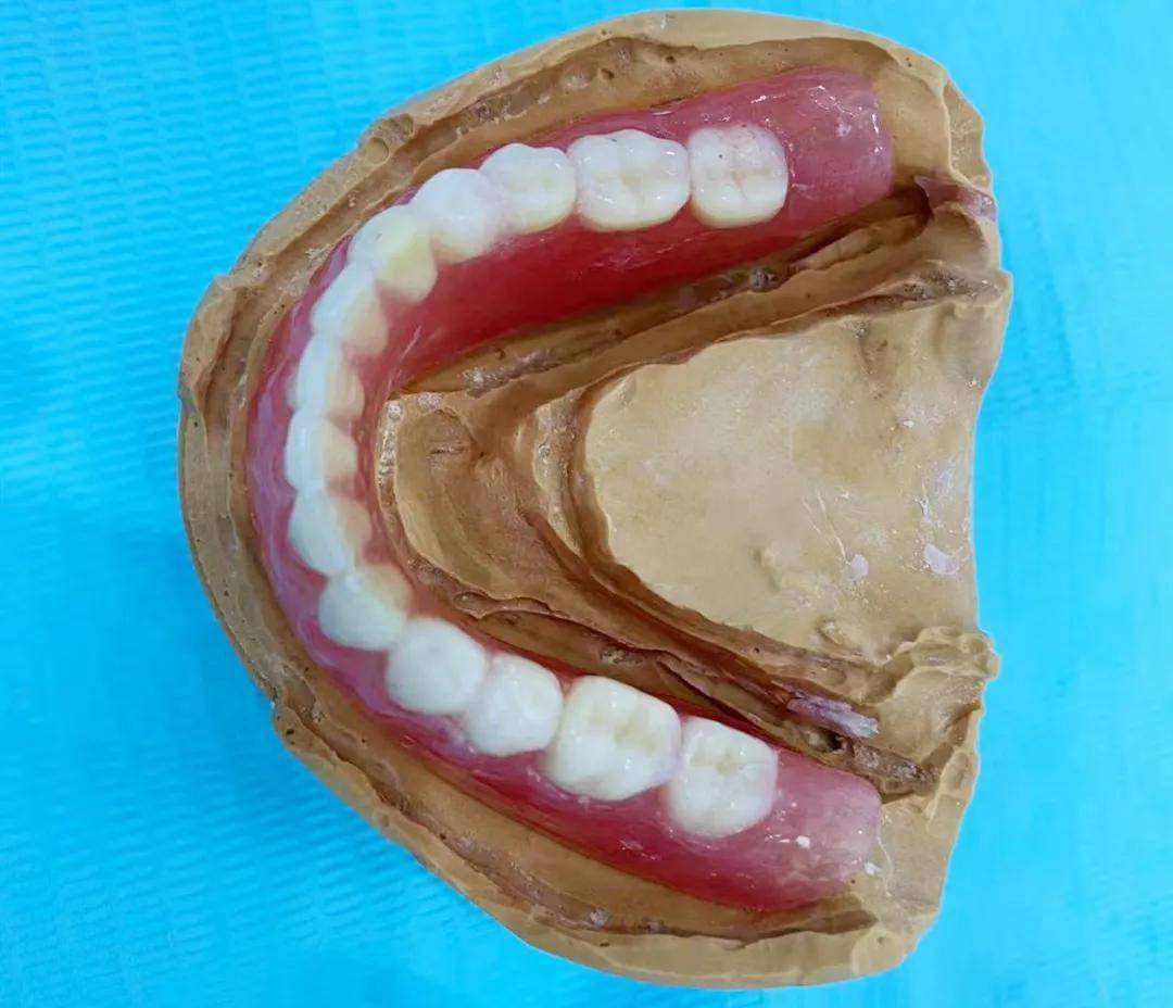 老年人做半口假牙哪种经济实惠?吸附性义齿/all-on-4种植牙都. - 牙科治疗 - 开立特口腔