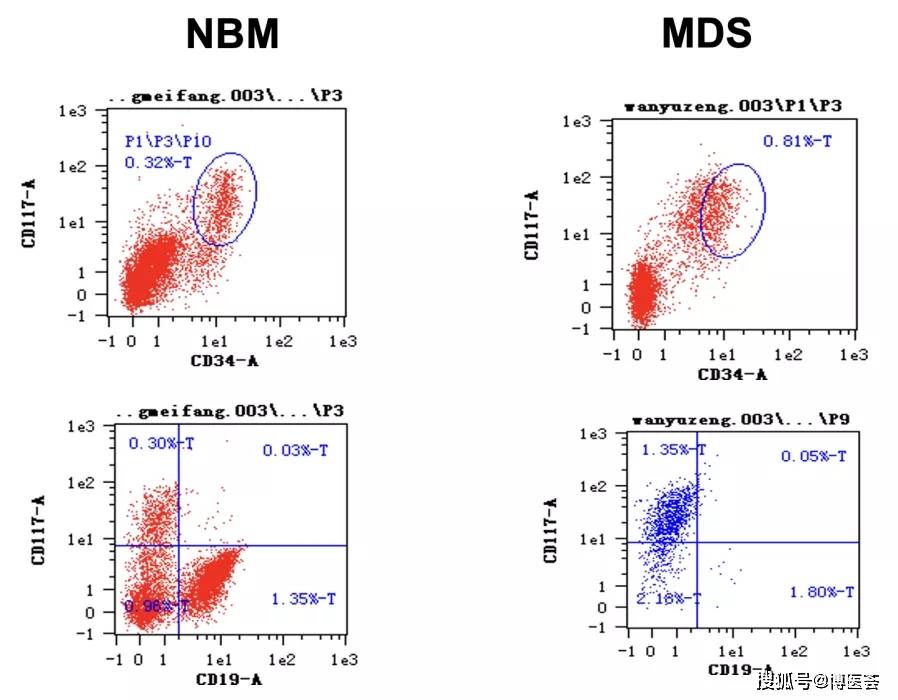 免疫分型在MDS/MPN诊断中的作用有哪些？刘艳荣教授带你一一破解_粒细胞_Ogata_标准