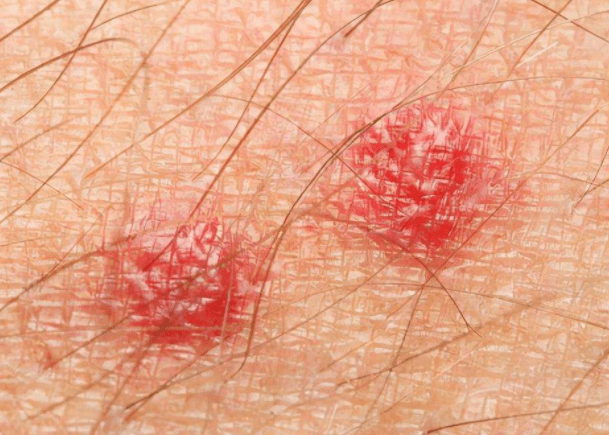 病毒在体内潜伏3~8周后,可能会导致外阴和肛门附近出现皮疹或疙瘩