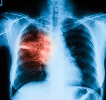 支气管|肺脓肿的病因，4种情况引发肺囊肿，愿你早知