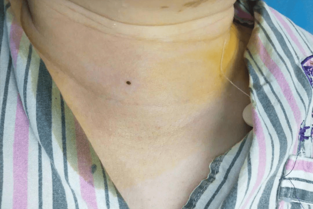 脖子上长了1厘米大的甲状腺结节,吓坏了她:不做手术可以吗?_患者_治疗