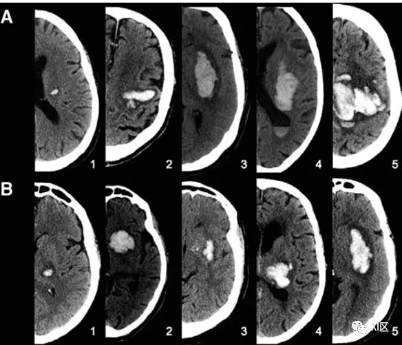 ct圖像中腦出血血腫擴大的十個徵象上