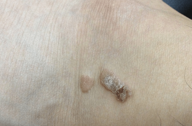 女大学生查出hpv情绪崩溃大哭医生手臂早有提醒太疏忽了