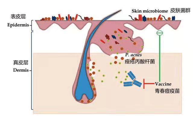 青春痘打一针永久不长痘，痘痘疫苗真有效吗？