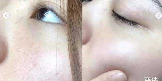 品牌继注射“玻酸”后，又一“抗衰老”方式走红，即安全还方便