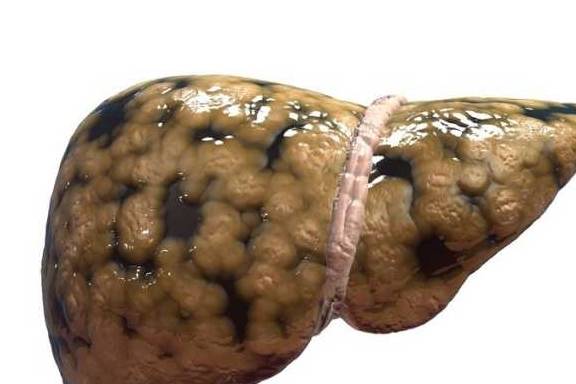 肝脏|2个症状一出现，说明肝已经被透支了