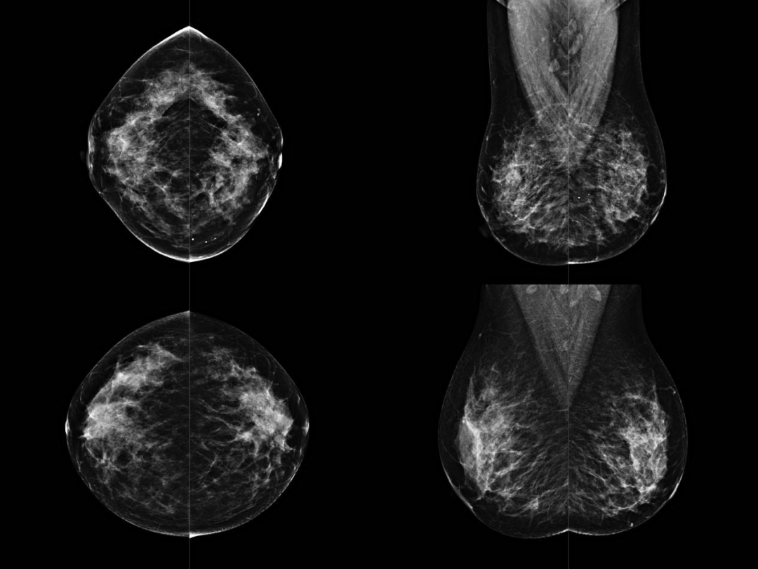 经产|智能乳腺DR 在高坪区人民医院投入临床使用