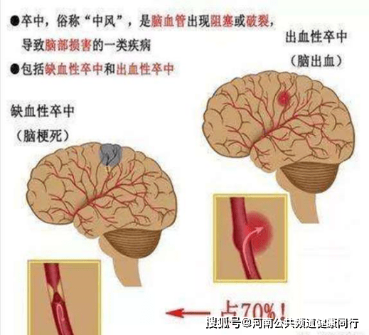 新宾|急性缺血性脑卒中的诊断和治疗——郑州大学第一附属医院神经介入科 郭新宾