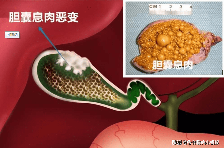 什么样的胆囊息肉需要切除看看最新版指南建议