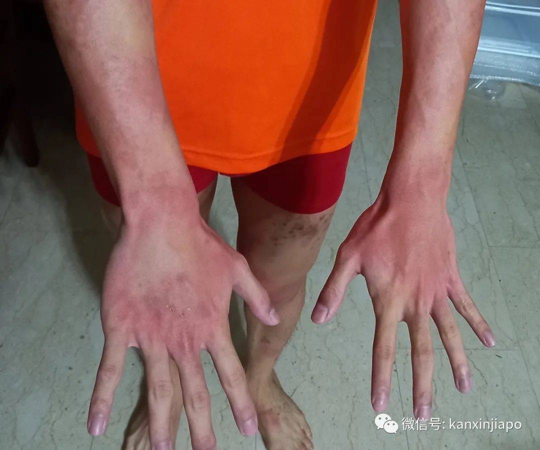 全身奇痒无比,新冠也能引起皮肤病?_儿子_隔离_症状