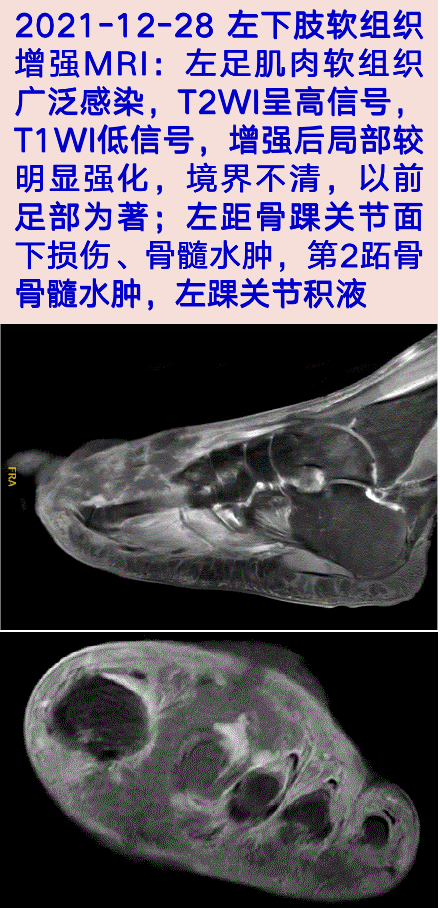 病史|皮肤感染后的并发症，非常震撼