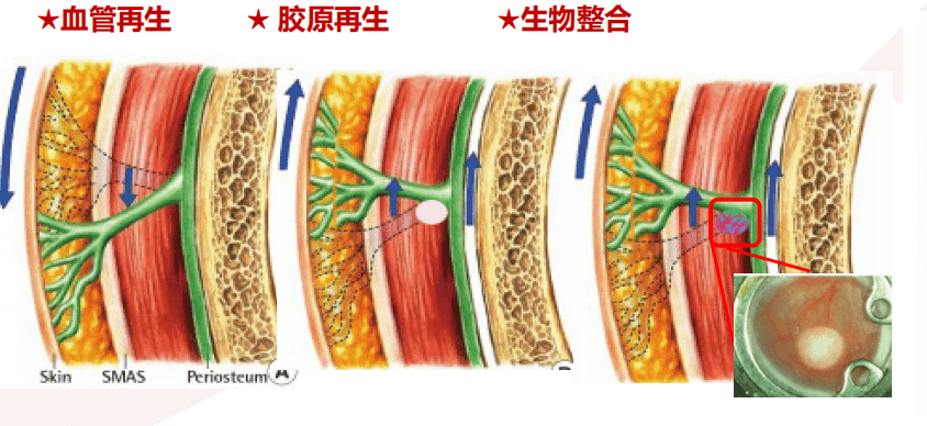 技术面部年轻化新型关键词为“提升&amp;再生”，爱缇恩mADM是如何做到的？