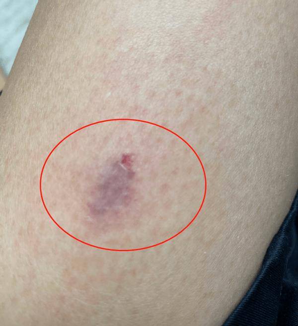 原创蔡少芬录制节目突然被狗咬伤口破皮红一大片深夜紧急前往医院