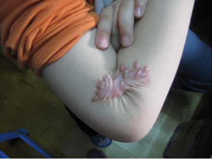 伤疤发痒的原因1,疤痕处于增生期:疤痕形成早期的1-3个月,局部充血