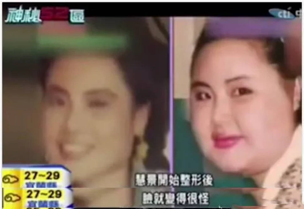 因为女星韩慧景：为了更漂亮，给脸注射食用油，把脸整成“猪头”