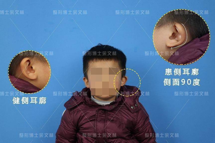 科普耳朵卷曲长得怪原来它叫杯状耳