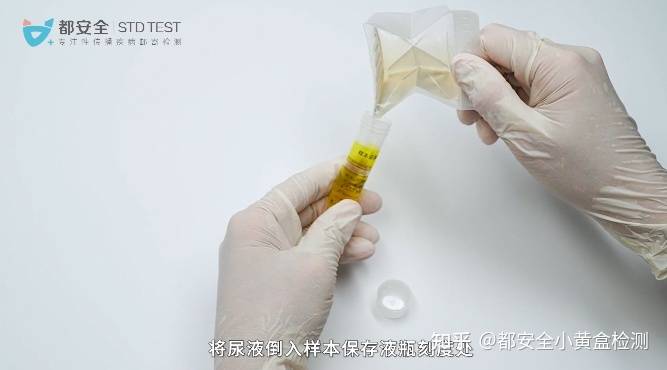 研究表明,在男性患者中,尿液和尿道拭子rna检测结果的一致性几乎可达