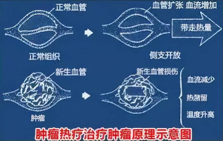 湖南省康复医院高温烫死癌细胞有效肿瘤热疗绿色治疗适合哪些患者