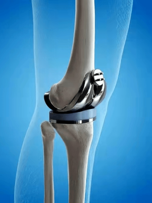 膝关节单髁置换术费用图片