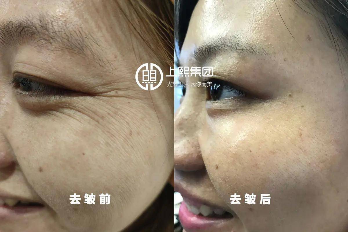 补充【上熙集团】28岁皮肤松弛、长皱纹该怎么办？