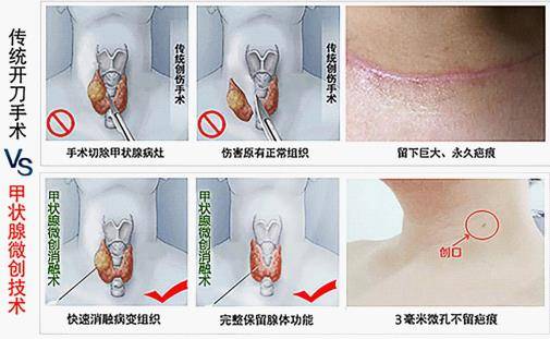 快稳准甲状腺结节微波消融术